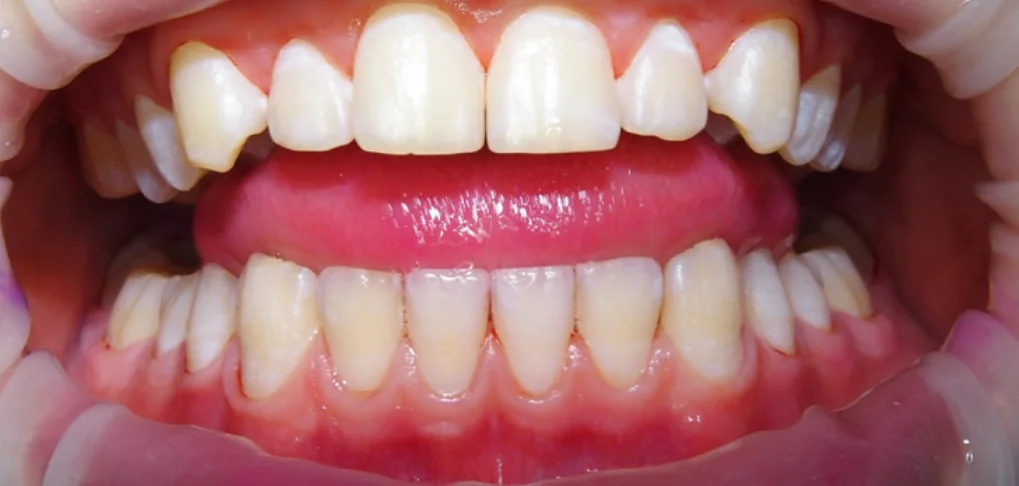 Gebit vóór het zichtbaar maken van biofilm